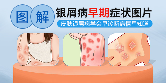 沈阳银屑病皮肤病医院